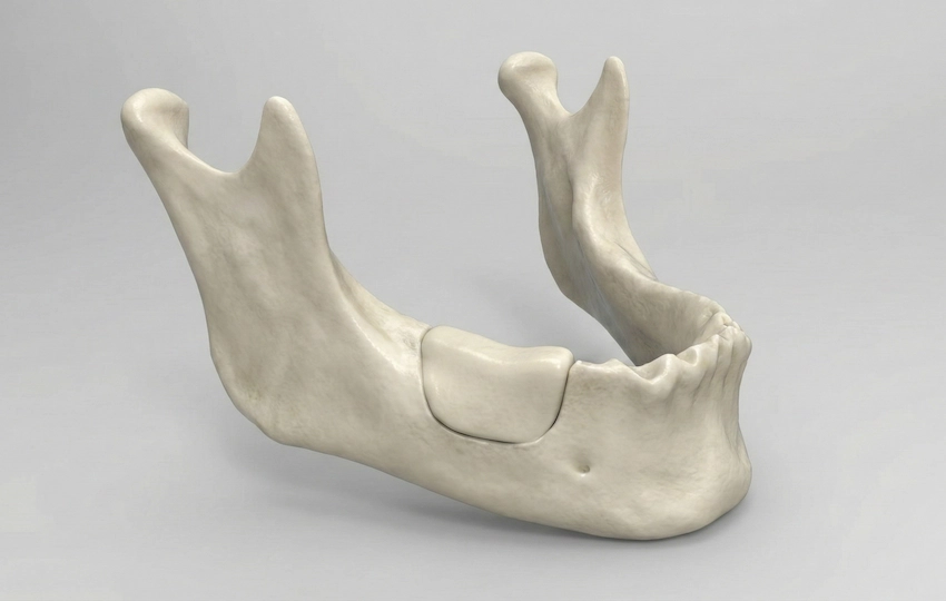 block bone graft jawbone reconstruction 3d block bone graft jawbone reconstruction 3d