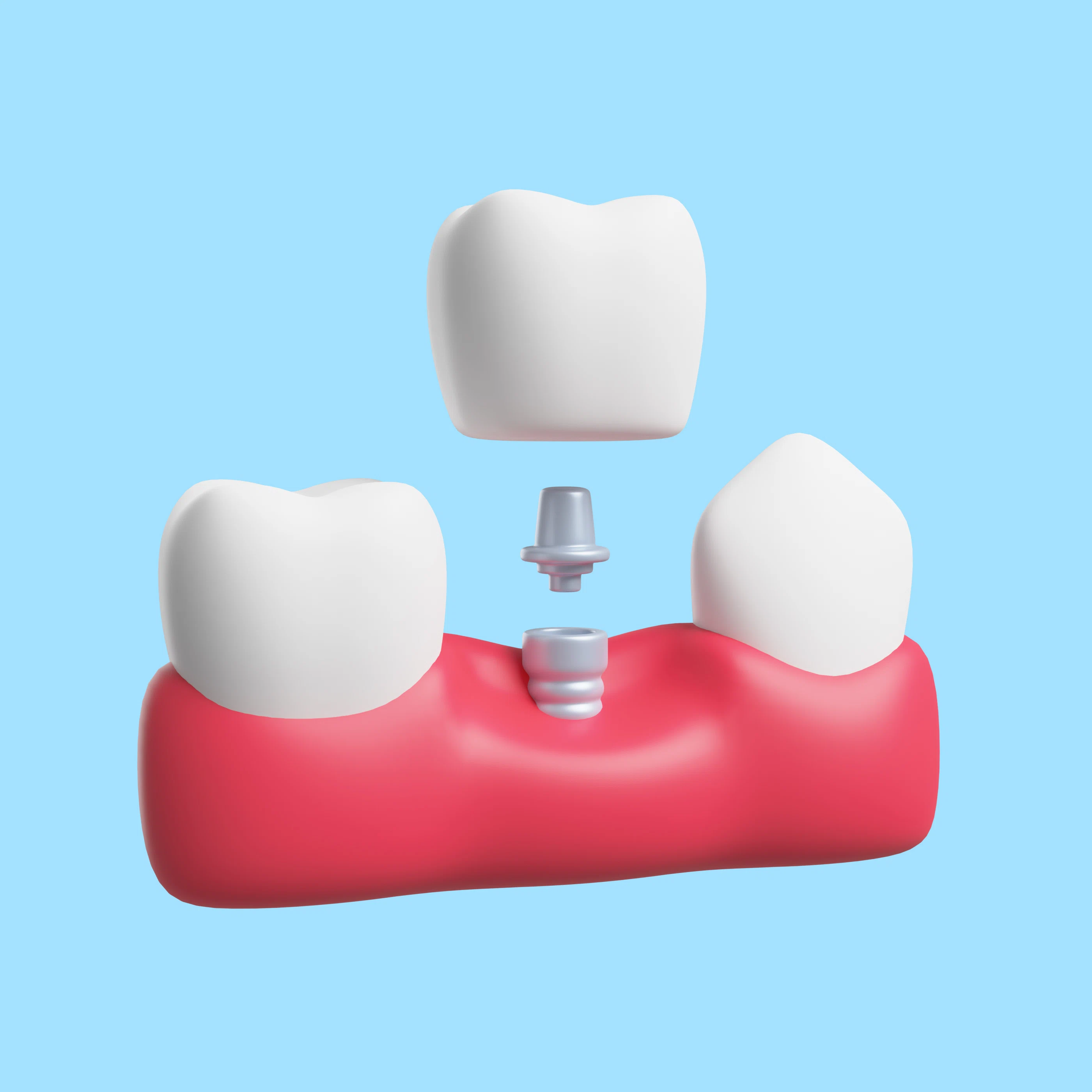 are Straumann are hiossen dental implants dental products strong safe