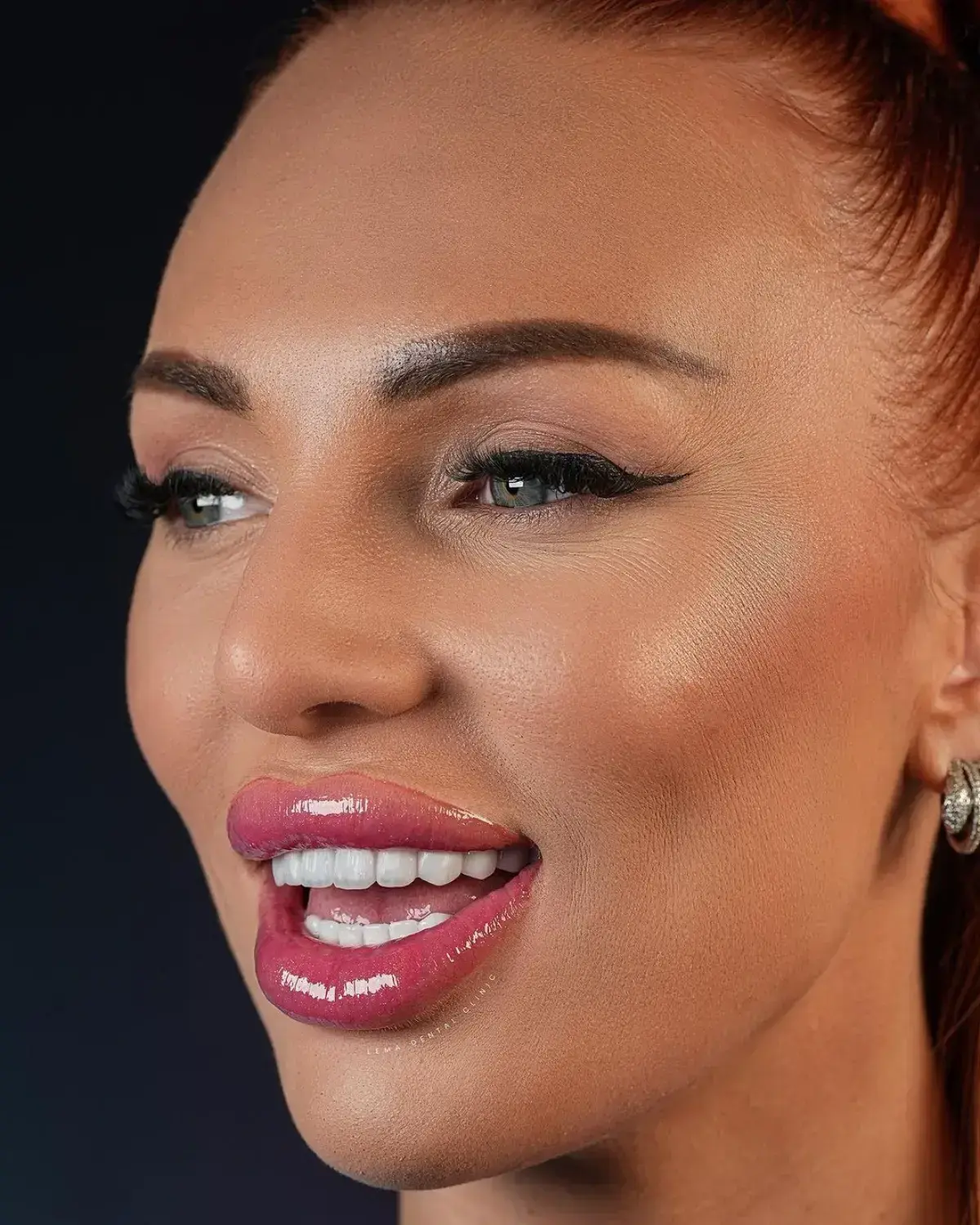 hollywood-smile-4.webp