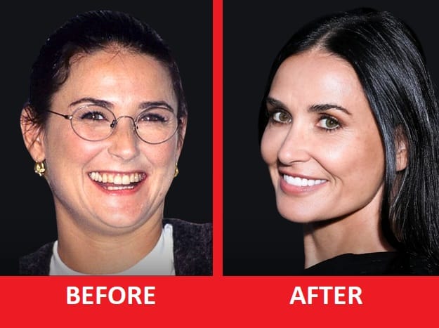 demi moore teeth before after