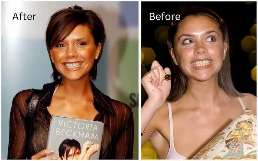 victoria beckham teeth before after
