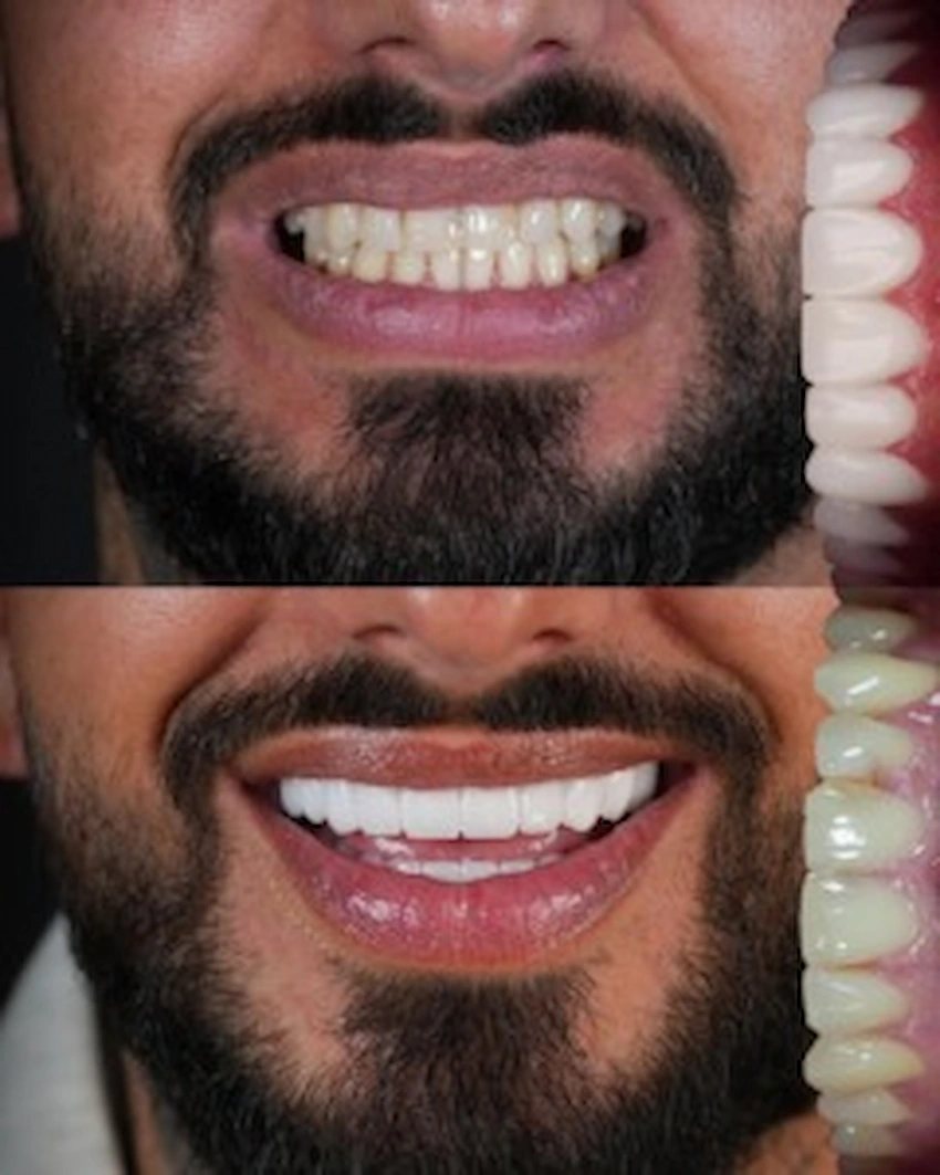Porcelain dental veneers