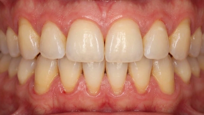 exposed-tooth-roots-from-gum-recession