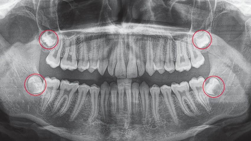 how can i brush my teeth after wisdom teeth extraction
