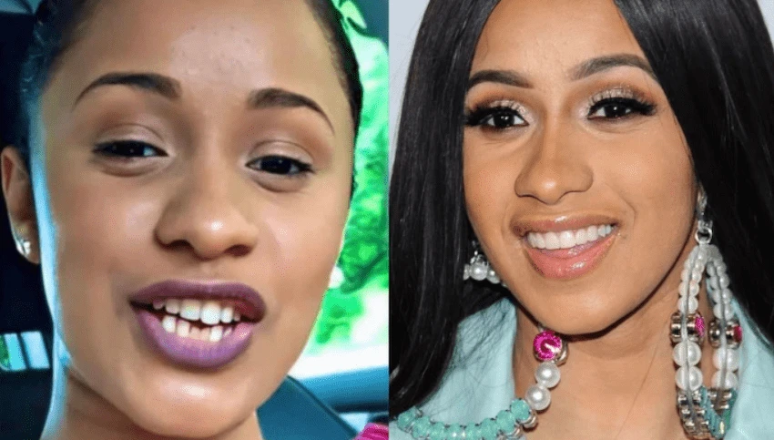 cardi b teeth before after