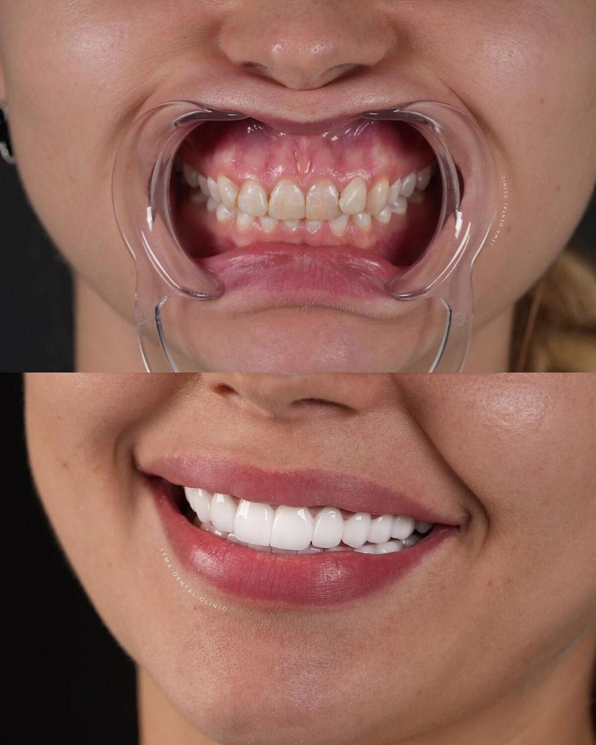 emax dental veneers