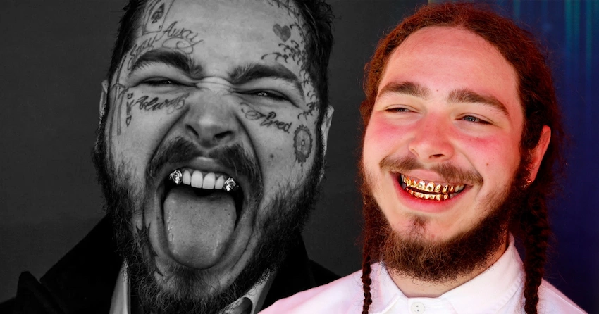 post malone teeth before after