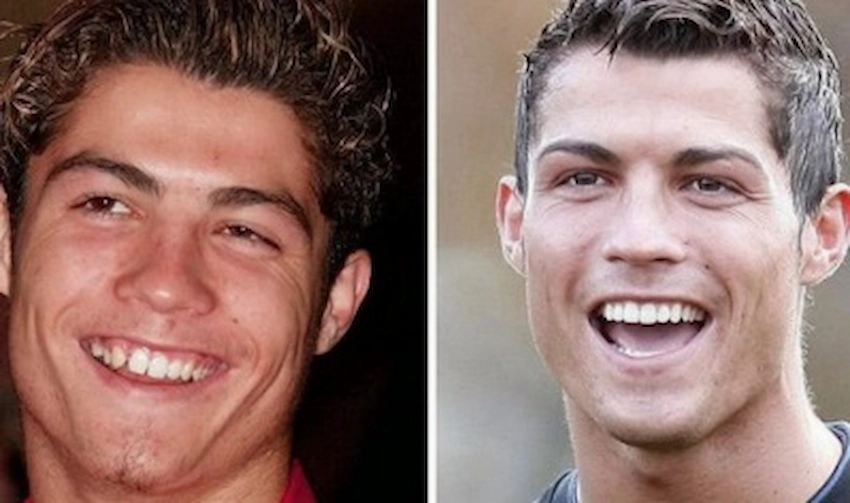 christiano ronaldo teeth