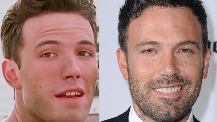 ben affleck teeth before after