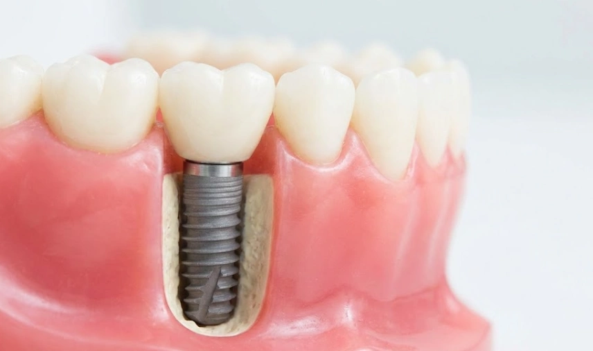a dental implant in jawbone