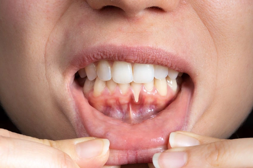 severe gum recession lower teeth