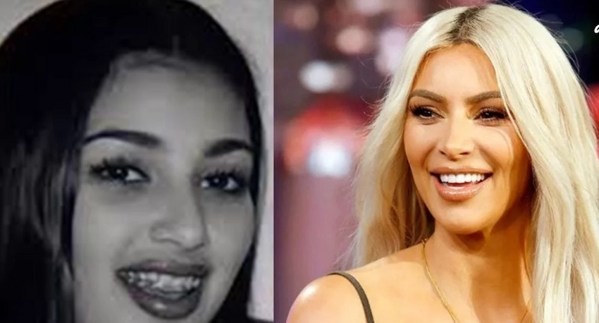 kim kardashian teeth before after