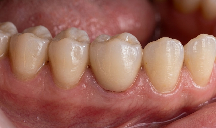 single ceramic dental crown restoration