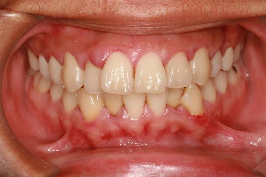 gum disease inflammation close up