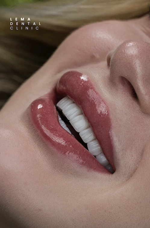 Best Dental Implants