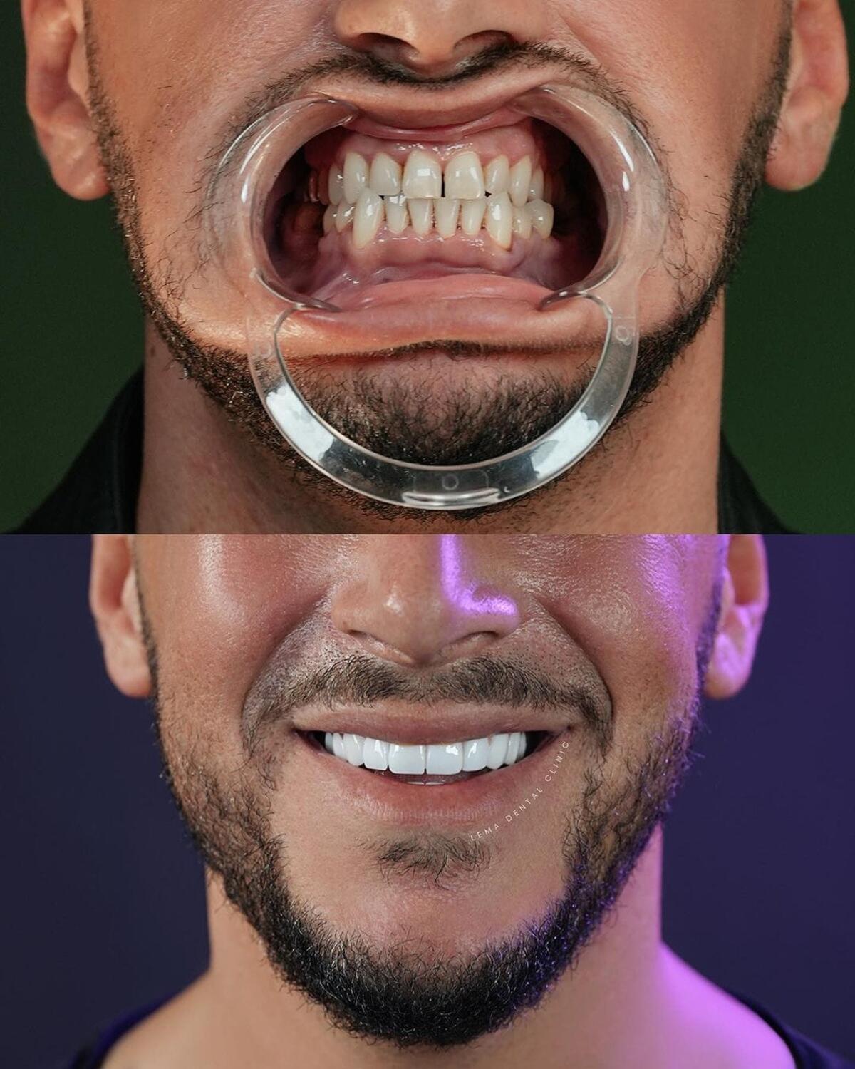 dental veneers cost
