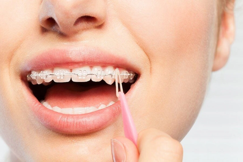 attaching rubber bands clear braces elastic placer