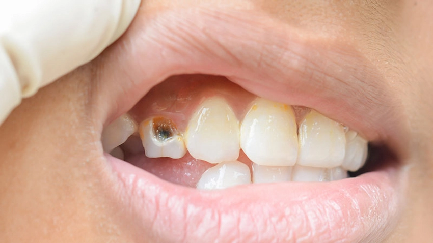 how to save a dead tooth causes symptoms and prevention
