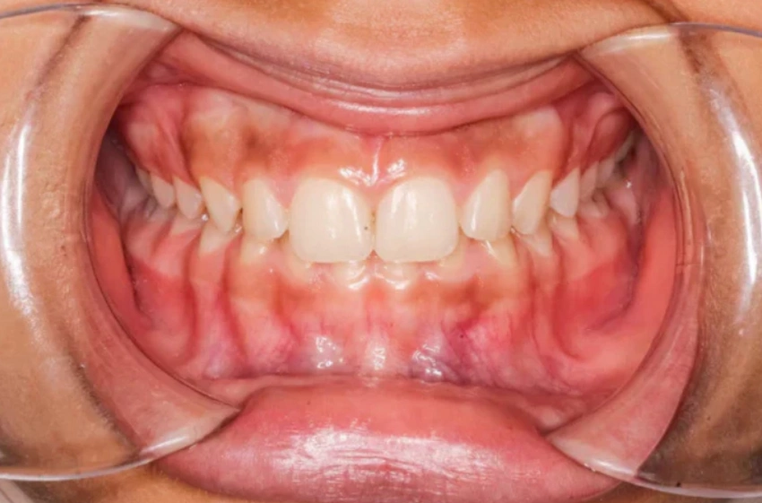 deep bite orthodontic case