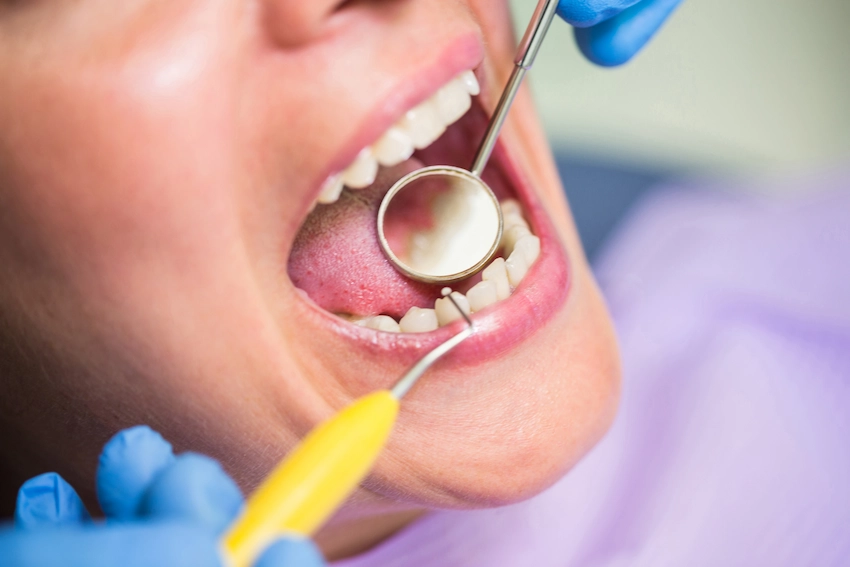 detailed view of teeth during dental exam