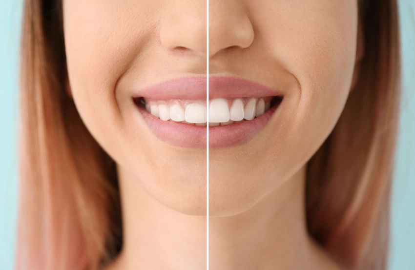 what is tooth contouring the art of a gentle smile