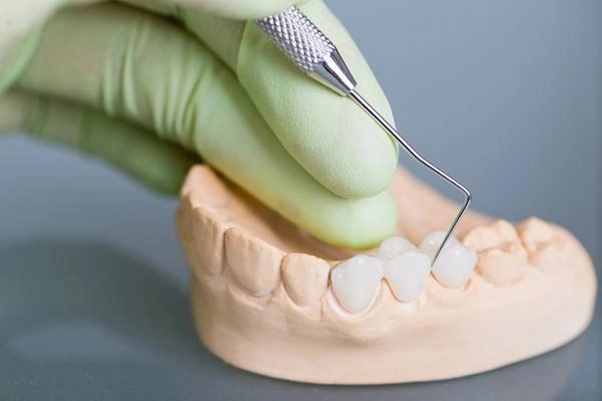is your dental bridge loose why adhesive is not the answer