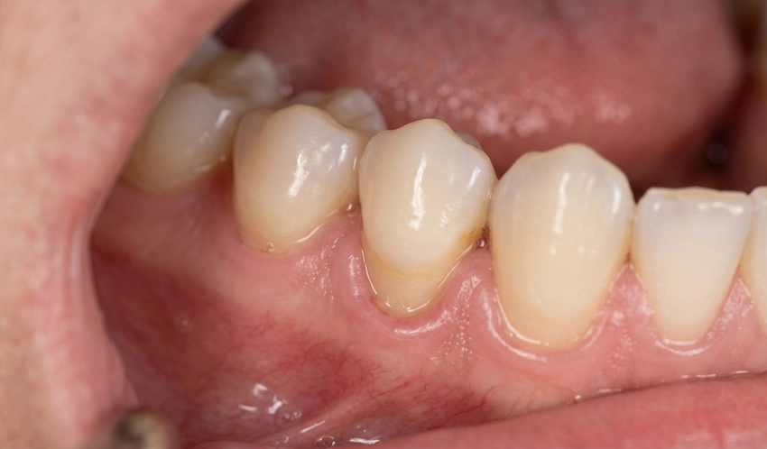 exposed tooth root gum recession symptoms
