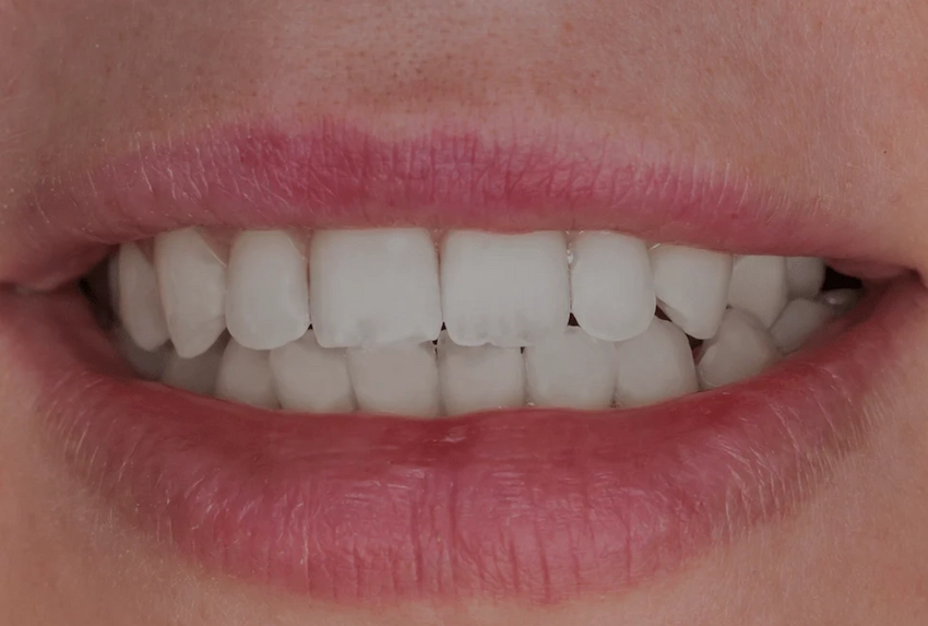 mild translucent teeth smile