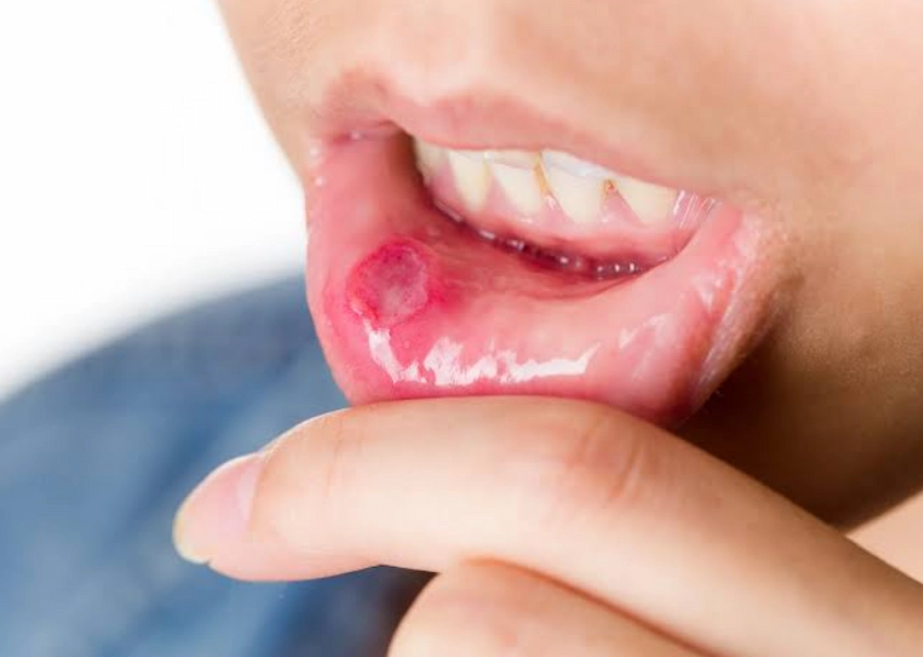 what is an aphthous ulcer and how does it heal