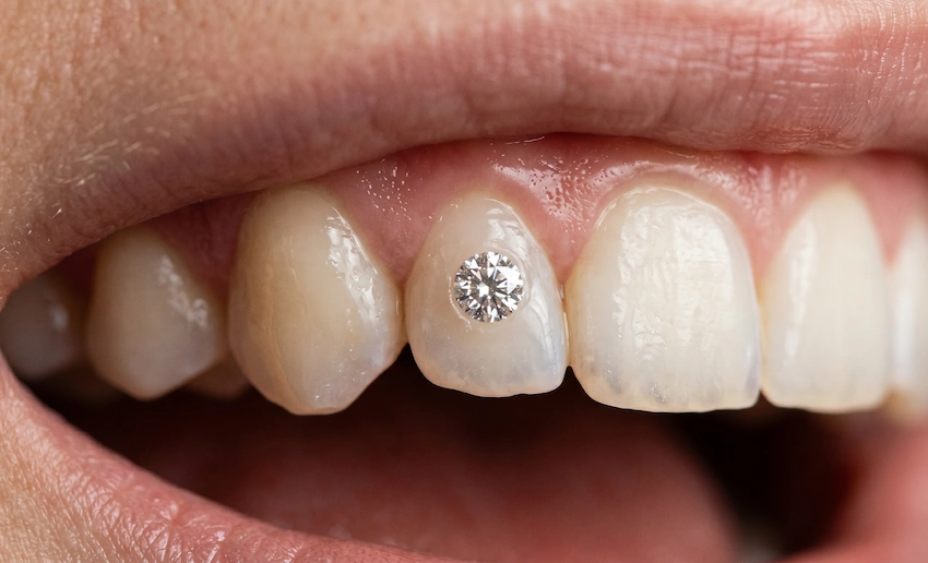 macro close up diamond tooth gem dental jewelry