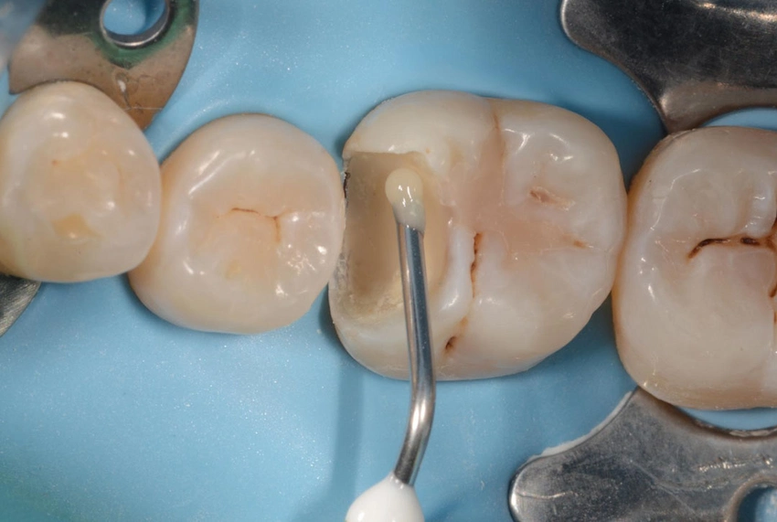 molar tooth caries acid etching procedure turkey