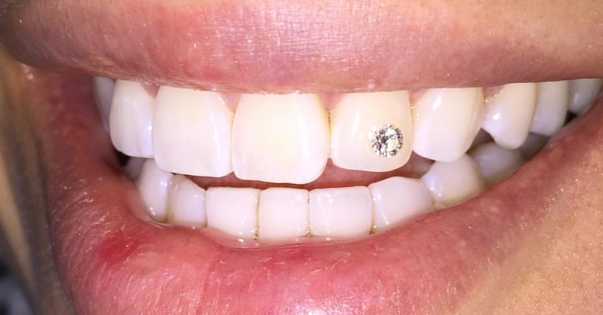 diamond tooth gem on white teeth