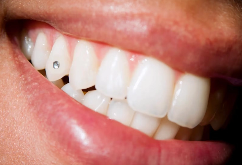 can you use denture adhesive for tooth gems a clinical reality